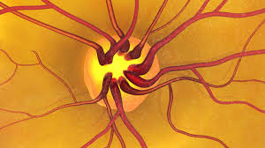 dilated eye exam