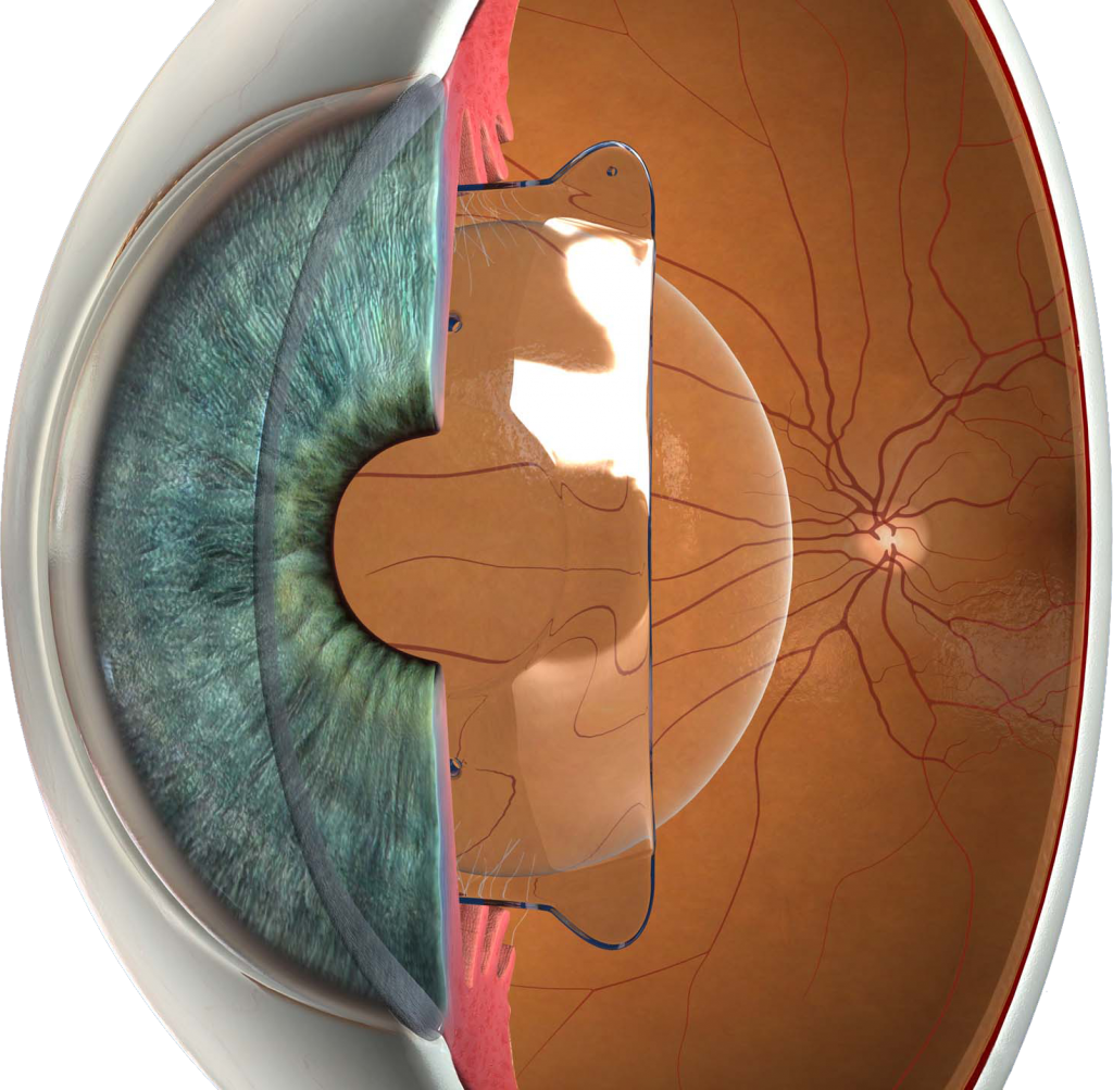 Visian Implantable Contact Lens